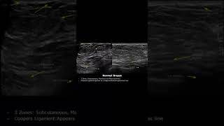 Normal Breast Anatomy Ultrasound  Subcutaneous Retromammary ZonesCooper Ligaments  USG shorts [upl. by Aihsak]