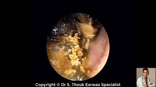 Earwax Removal Extraction Cholesteatoma surgery Dr Thouk Earwax Specialist [upl. by Orban]