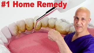 1 Home Remedy to Remove Dental Plaque amp Tarter to Prevent Cavities  Dr Mandell [upl. by Ludwog]