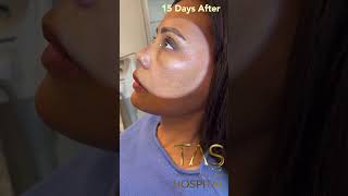 Scarless Facelift by DrTAS [upl. by Anerat]