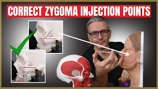 Injecting the Zygoma  Safety Advice amp Injection Points [upl. by Laith]