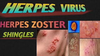 Best Ayurvedic Medicine For Herpes  हार्पीज़ नी देसी दबा  Genital Herpes  Herpes Zoster [upl. by Einad]