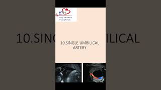 Single umbilical artery  What should we do SUA [upl. by Matteo]