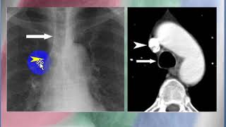 Widening of paratracheal stripes [upl. by Nebeur]