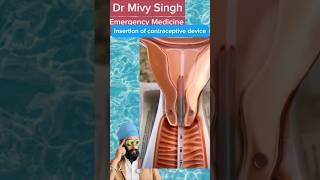 Inserting Contraceptive Device contraception contraceptives uterus [upl. by Eseneg241]