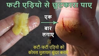 फटी एड़ियो से छुटकारा पाने का अचूक उपायCracked Heels Home Remedy  Cracked Heels Treatment [upl. by Alexi669]