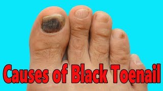 CAUSES OF BLACK TOENAIL HOW TO GET RID OF A BLACK TOENAIL CURE OF BLACK TOENAIL FOOTLOOSE [upl. by Alyag570]