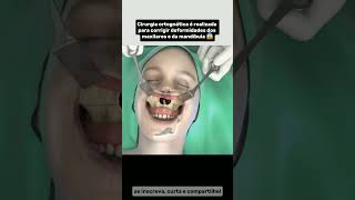 Cirurgia ortognática é realizada para corrigir deformidades dos maxilares e da mandíbula 😱 shorts [upl. by Ullyot982]