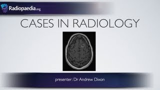 Cases in Radiology Episode 1 neuroradiology CT MRI [upl. by Aimal]