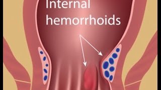 Hemorrhoid Treatment with Colorectal Surgeon Dr Jennifer Lowney [upl. by Cut558]