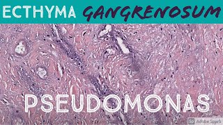 Ecthyma Gangrenosum Pseudomonas aeruginosa 5Minute Pathology Pearls Dermatology Dermatopathology [upl. by Sucramraj929]