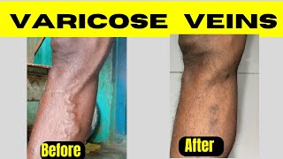 Laser treatment of varicose veins Diode laser ablation of varicose veins Varicose veins treatment [upl. by Dihgirb]