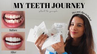 MY TEETH JOURNEY  Invisalign Composite Bonding Whitening  Answering All Your Questions [upl. by Quintin]