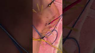 Ankle Pain Peroneus Tendon Dry Needling with Electrical Stimulation dryneedlingtherapy anklepain [upl. by Obla]