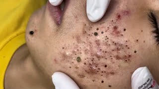 Big Cystic Acne Blackheads Extraction Blackheads amp Milia Whiteheads Removal Pimple Popping  9000 [upl. by Naltiak251]