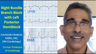 Right bundle branch block with left posterior hemiblock [upl. by Halland]