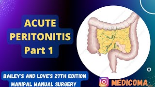 ACUTE PERITONITIS  PART 1  Etiology Pathogens Pathophysiology Types of peritonitis [upl. by Naellij]