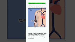 peripherally inserted central catheter medicaleducation catheter nursing [upl. by Iain]