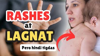 RASHES at LAGNAT sa bata pero hindi TIGDASANO GAGAWINDr PediaMom [upl. by Ogu]