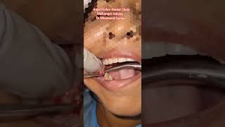 Surgical extraction of lower right third molarwisdom tooth painful last vestigial tooth removal [upl. by Irita]