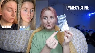 my acne journey  lymecycline [upl. by Ralat]