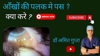 आँख की पलकों मे पस  Meibomitis eyecare Video258 [upl. by Kling]