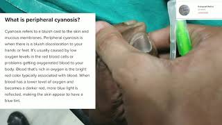 Peripheral Cyanosis  Practical viva  Clinical [upl. by Song]