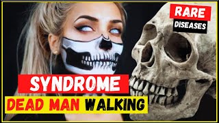 Cotards syndromesyndrome dead walking what is symptoms causes and treatment  Most rare disease [upl. by Arty835]