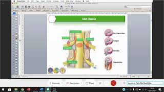 Degenerative Spine Disease [upl. by Vallonia]