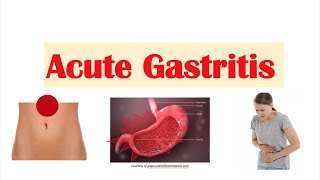 Acute Gastritis Stomach Inflammation  Causes Signs amp Symptoms Diagnosis Treatment [upl. by Nigle537]