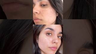 How I Reduced My Pigmentation In 2 weeks😍 [upl. by Sirron]