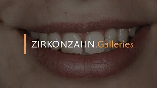 Prettau® veneers with PlaneSystem® and Face Hunter  ZirkonzahnGalleries [upl. by Jerrine]