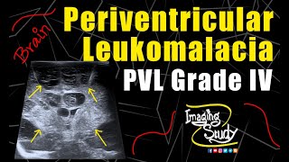 Periventricular Leukomalacia Grade IV  Ultrasound  Case 146 [upl. by Anoirb]