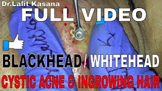 COMEDONES and CYSTIC ACNE POPPING FULL VIDEO 2 [upl. by Anitnamaid]