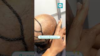 How is this a Sew In 🤯 Alopecia Illusions hairtransformation alopecia atlhairstylist [upl. by Marilee]