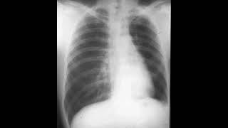 Parenchymal causes  emphysema  swyer james mcleod syndrome [upl. by Neelac]