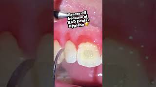 What if I dont brush my teeth with braces Tooth Time Family New Braunfels Texas [upl. by Ellynad]