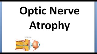 Ophthalmology 334 Optic Atrophy Primary Secondary Consecutive Marcus Gunn Pupil RAPD drusen [upl. by Hardie]