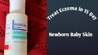 Desonide Lotion Treat Eczema in 15 Days for Newborn BabyToddler [upl. by Socram]