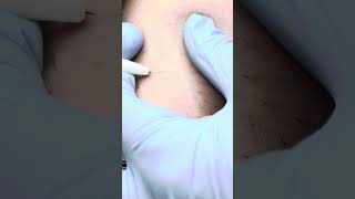 Relaxing electrolysis hair removal Zap hairs with me [upl. by Alyakim]