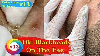 Old Blackheads In The Mans Face  Care Of Acne Treatment 13 [upl. by Inaflahk]