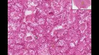 Histopathology ThyroidGraves Disease [upl. by Neelik]