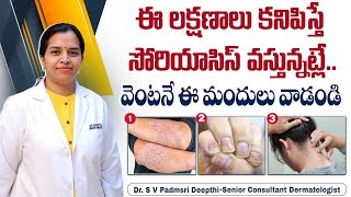 సోరియాసిస్ లక్షణాలు ఇవే  Psoriasis Skin Disease in Telugu  Psoriasis Symptoms  HRC Hospital [upl. by Airotciv282]