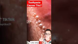 Huge BLACKHEAD REMOVAL FROM LIPS 😲 shorts [upl. by Aihsia]