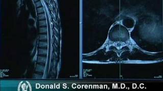 How to Read a MRI of the Normal Thoracic Spine Mid Back  Vail Spine Specialist [upl. by Sew113]