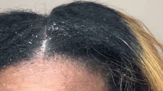 Stubborn Flakes Dandruff Scratching Psoriasis Stuck to Scalp 60 Second Clip [upl. by Chadburn]