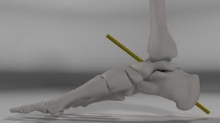 Over Pronation amp Supination Motion Biomechanics of the Subtalar Joint Explained [upl. by Winthorpe]