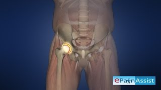 Hip Joint Arthroscopy To Know The Cause Of Hip Pain [upl. by Zoeller417]