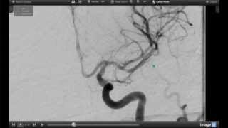 How Endovascular Stroke Treatment Works [upl. by Phyllida]