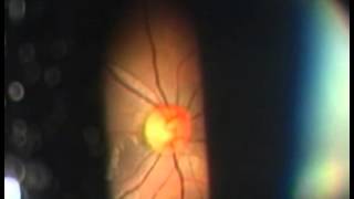 Entire Attack With Pupillary Reaction and Fundus Image [upl. by Yltneb790]